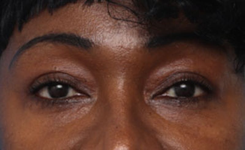 Eyelid Surgery Before & After Gallery - Patient 387961 - Image 2