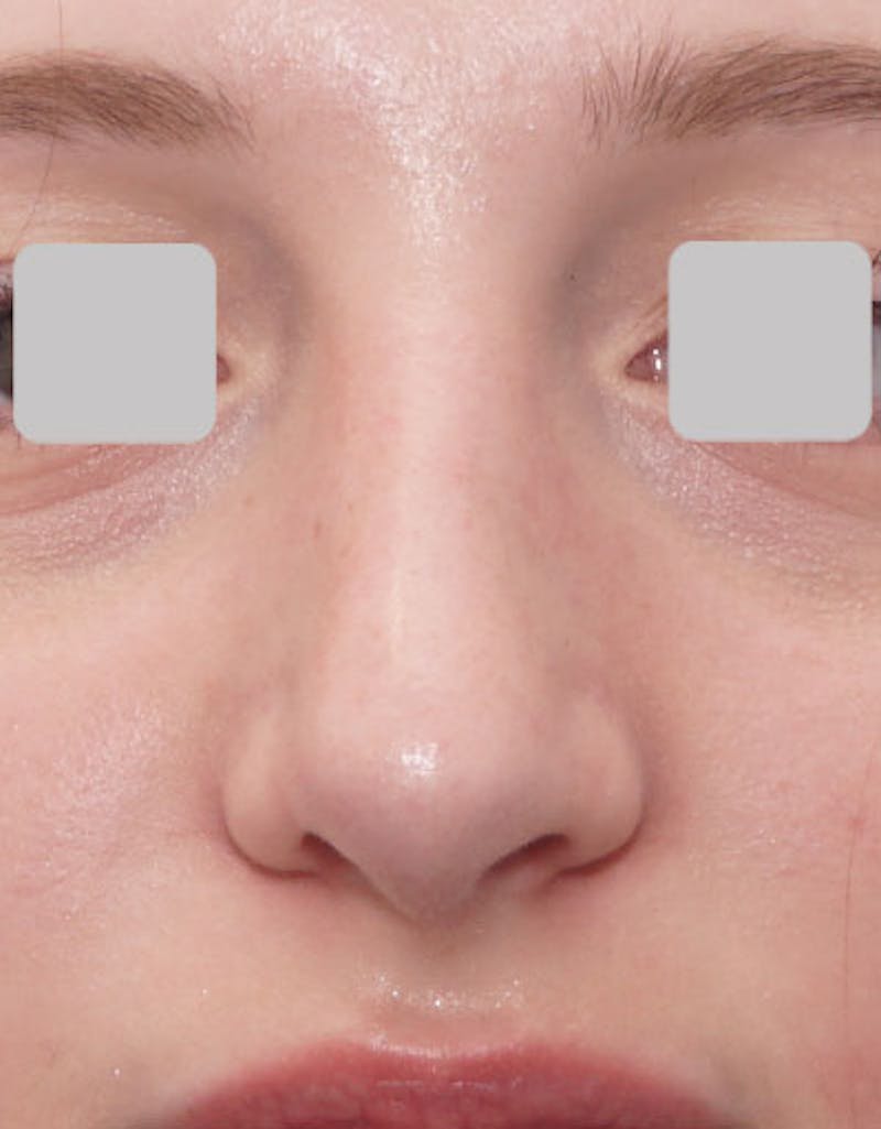 Rhinoplasty Before & After Gallery - Patient 282134 - Image 4