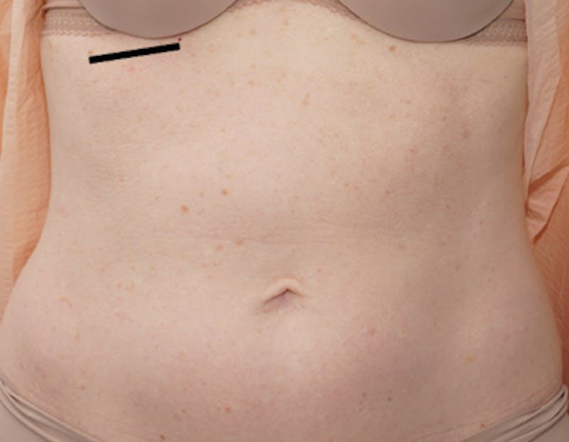 Liposuction (Body) Before & After Gallery - Patient 352394 - Image 5