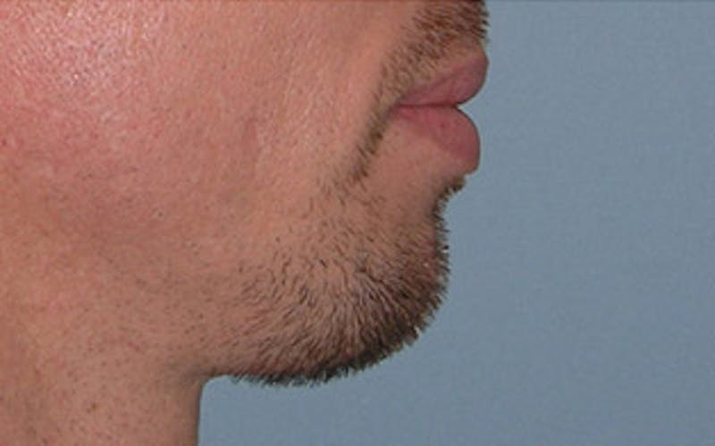 Chin Surgery Before & After Gallery - Patient 346731 - Image 1