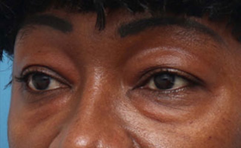 Eyelid Surgery Before & After Gallery - Patient 387961 - Image 3