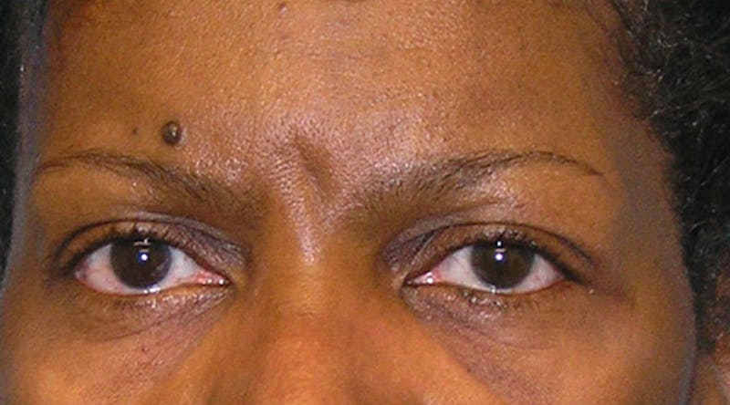 Patient TbCJgAY4Qhip1ToAjvJkNA - BOTOX Before & After Photos