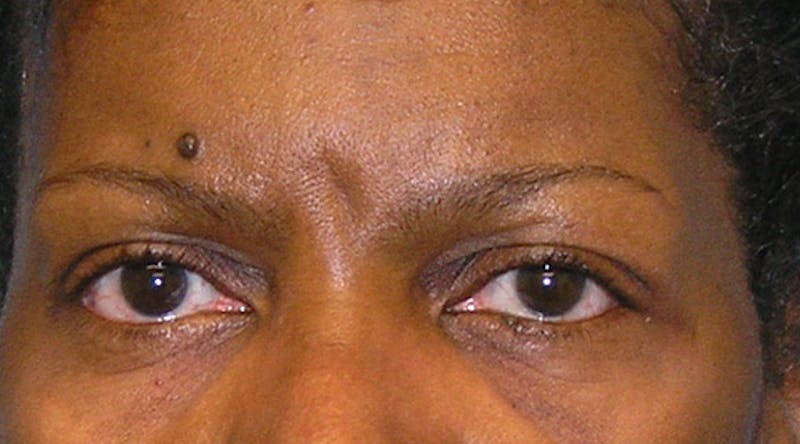 BOTOX Before & After Gallery - Patient 354936 - Image 1
