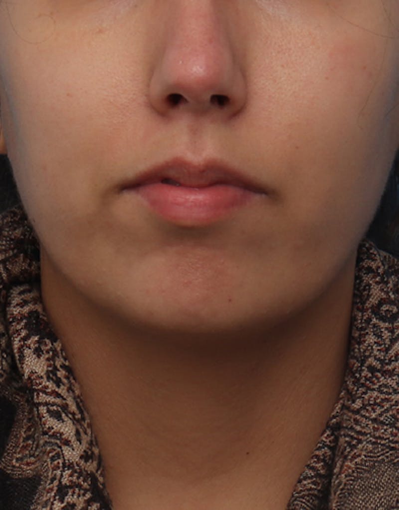 Chin Surgery Before & After Gallery - Patient 368478 - Image 5