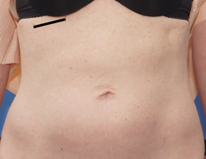 Liposuction (Body) Before & After Gallery - Patient 352394 - Image 6