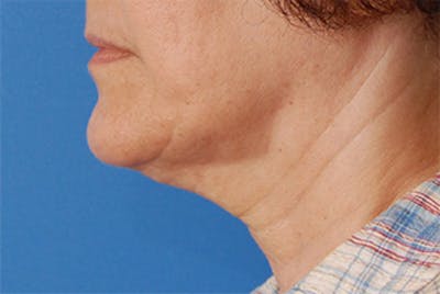 Facelift Before & After Gallery - Patient 119743 - Image 1