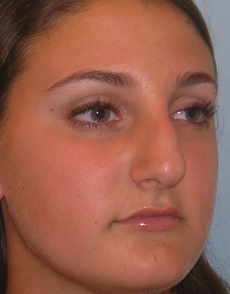 Rhinoplasty Before & After Gallery - Patient 282134 - Image 5