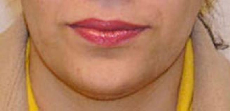 Neck Liposuction Before & After Gallery - Patient 232821 - Image 3