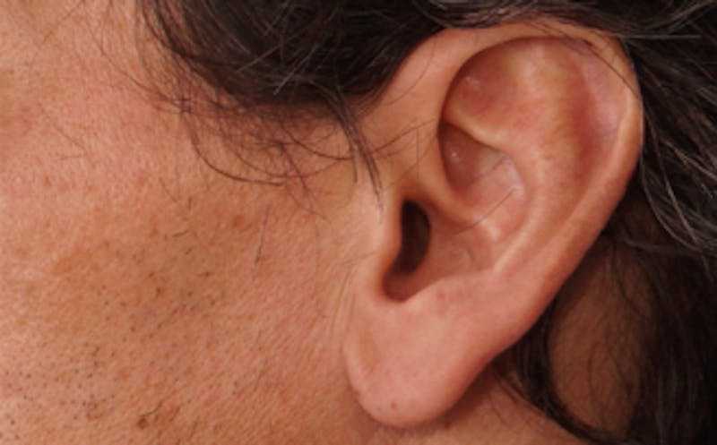 Ear Surgery Before & After Gallery - Patient 113025 - Image 1