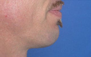 Chin Surgery Before & After Gallery - Patient 346731 - Image 2