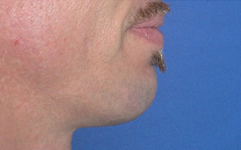 Chin Surgery Before & After Gallery - Patient 346731 - Image 2