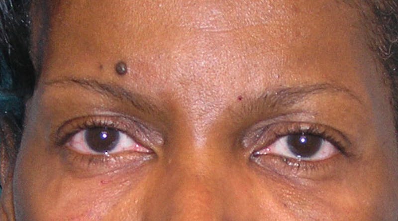 BOTOX Before & After Gallery - Patient 354936 - Image 2