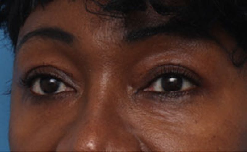 Eyelid Surgery Before & After Gallery - Patient 387961 - Image 4