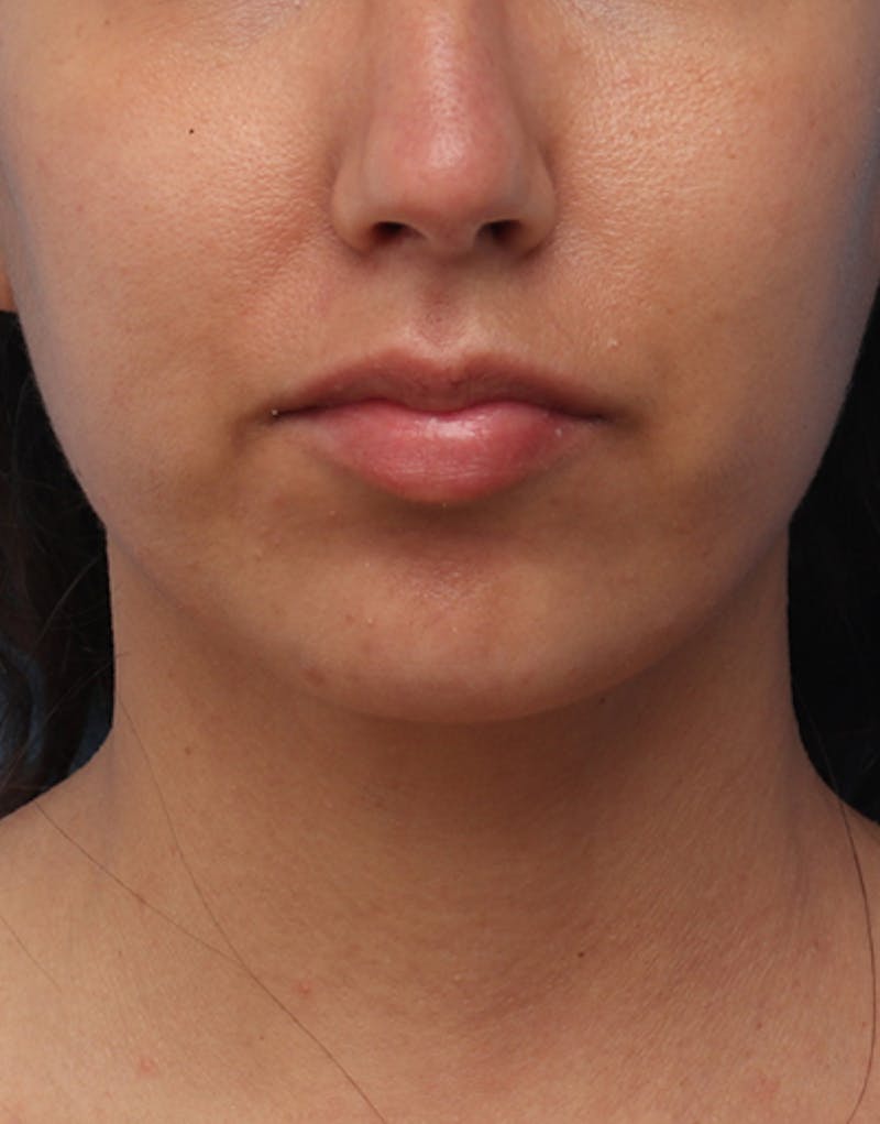 Chin Surgery Before & After Gallery - Patient 368478 - Image 6