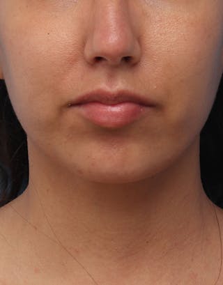 Chin Surgery Before & After Gallery - Patient 368478 - Image 6