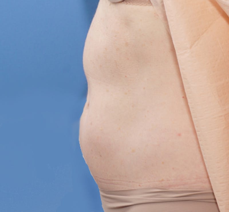Liposuction (Body) Before & After Gallery - Patient 352394 - Image 7