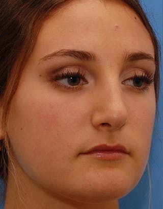 Rhinoplasty Before & After Gallery - Patient 272307 - Image 2