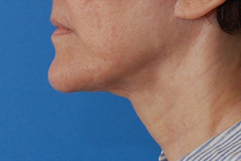 Facelift Before & After Gallery - Patient 119743 - Image 2
