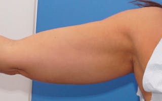 BodyTite Before & After Gallery - Patient 181372 - Image 6