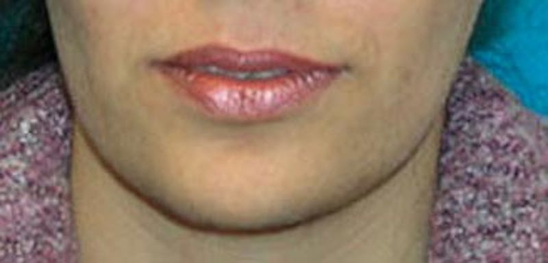 Neck Liposuction Before & After Gallery - Patient 232821 - Image 4