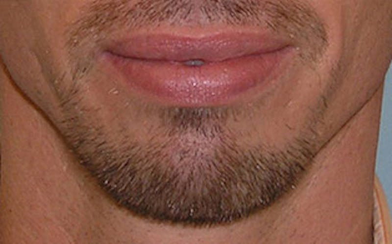 Chin Surgery Before & After Gallery - Patient 346731 - Image 3