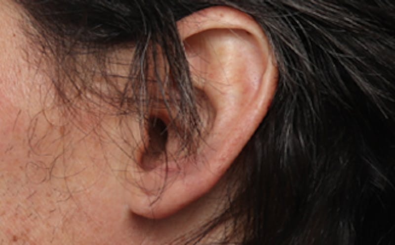 Ear Surgery Before & After Gallery - Patient 113025 - Image 2