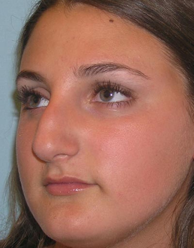 Rhinoplasty Before & After Gallery - Patient 282134 - Image 7