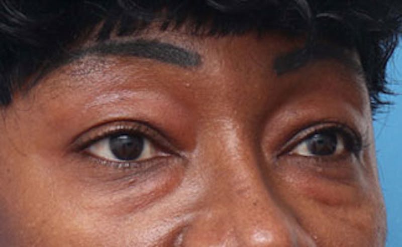 Eyelid Surgery Before & After Gallery - Patient 387961 - Image 5