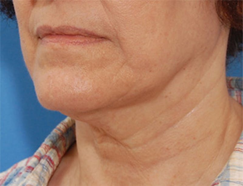 Facelift Before & After Gallery - Patient 119743 - Image 3