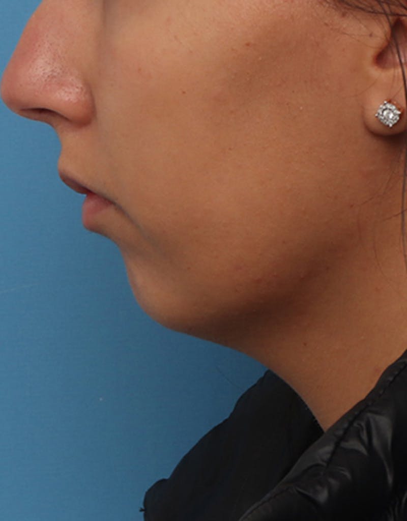 Neck Liposuction Before & After Gallery - Patient 382631 - Image 7