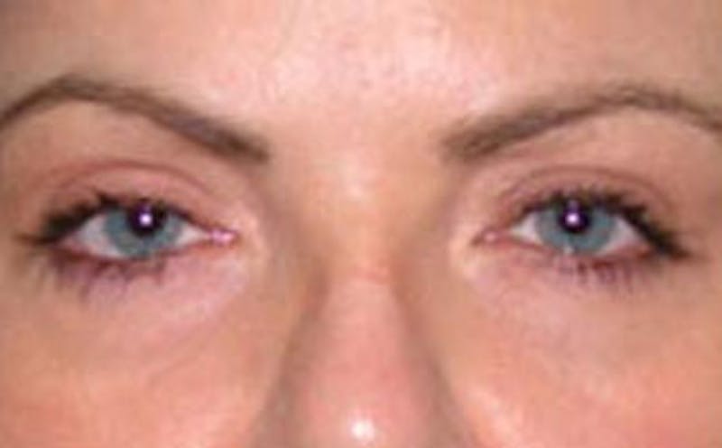 BOTOX Before & After Gallery - Patient 399399 - Image 1