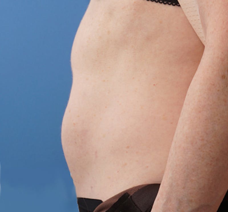 Liposuction (Body) Before & After Gallery - Patient 352394 - Image 8