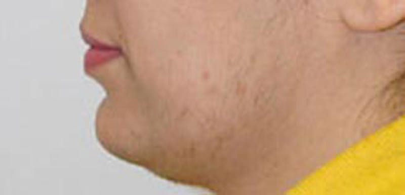Patient JbTnnuuyTaeNTcEjukQY9w - Jawline Contouring Before & After Photos