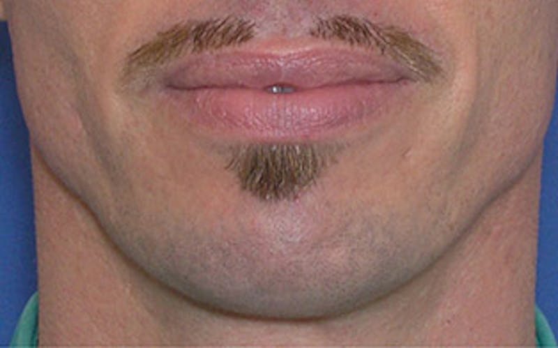Chin Surgery Before & After Gallery - Patient 346731 - Image 4