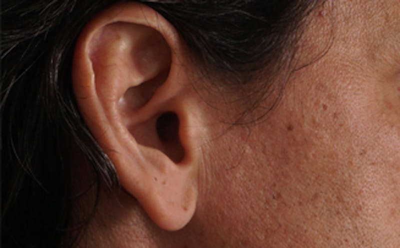 Ear Surgery Before & After Gallery - Patient 113025 - Image 3
