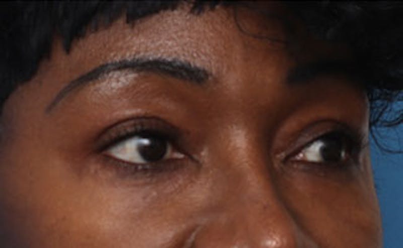 Eyelid Surgery Before & After Gallery - Patient 387961 - Image 6
