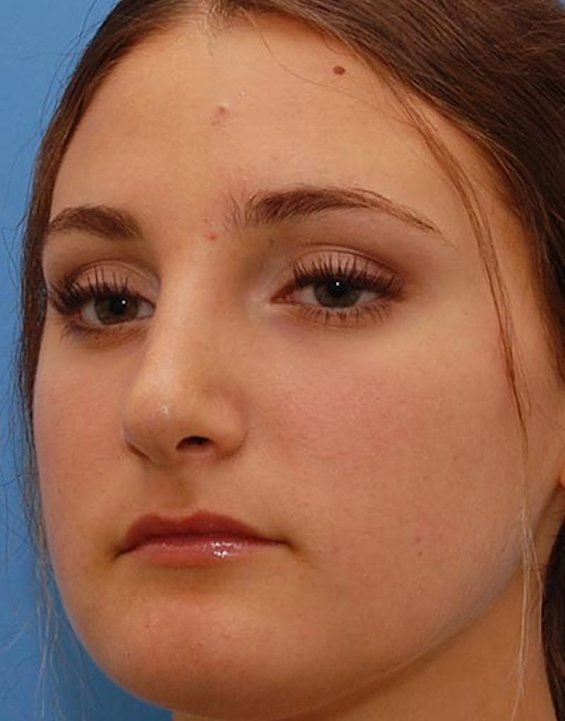 Rhinoplasty Before & After Gallery - Patient 282134 - Image 8