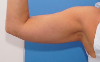 BodyTite Before & After Gallery - Patient 181372 - Image 8