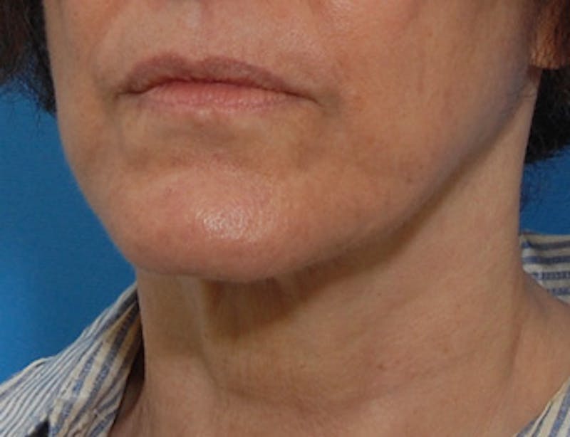 Facelift Before & After Gallery - Patient 119743 - Image 4