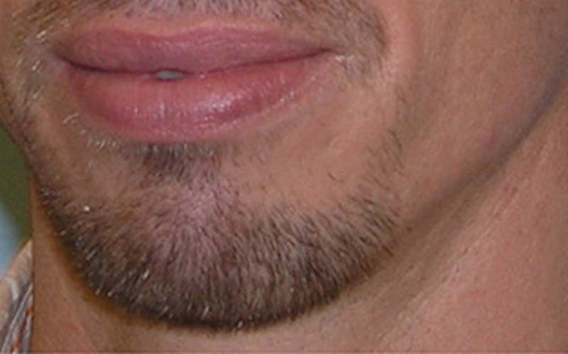 Chin Surgery Before & After Gallery - Patient 346731 - Image 5