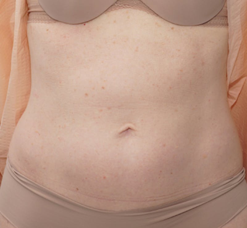 Liposuction (Body) Before & After Gallery - Patient 352394 - Image 9