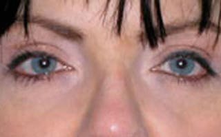 BOTOX Before & After Gallery - Patient 399399 - Image 2