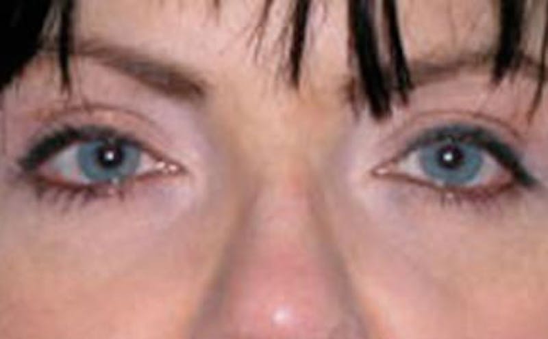 BOTOX Before & After Gallery - Patient 399399 - Image 2