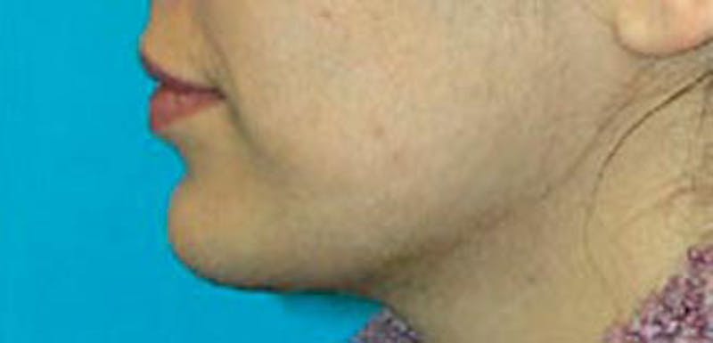 Jawline Contouring Before & After Gallery - Patient 153214 - Image 4