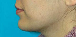 Neck Liposuction Before & After Gallery - Patient 232821 - Image 2