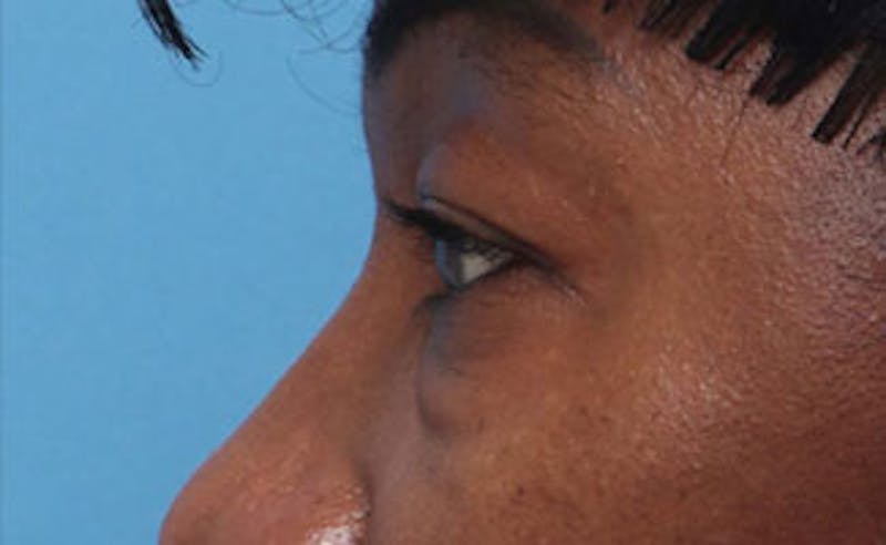 Eyelid Surgery Before & After Gallery - Patient 387961 - Image 7