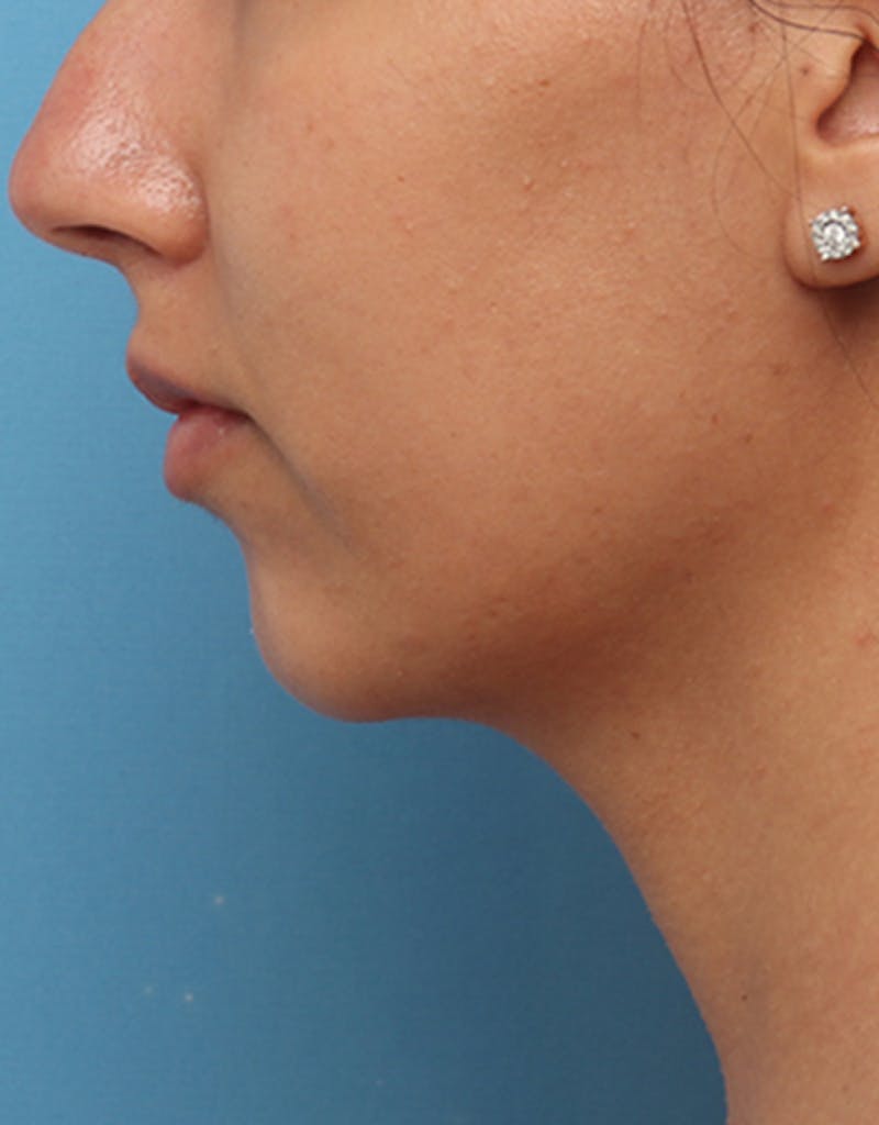 Chin Surgery Before & After Gallery - Patient 368478 - Image 8