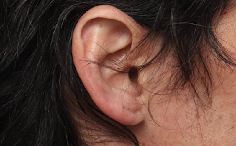 Ear Surgery Before & After Gallery - Patient 113025 - Image 4