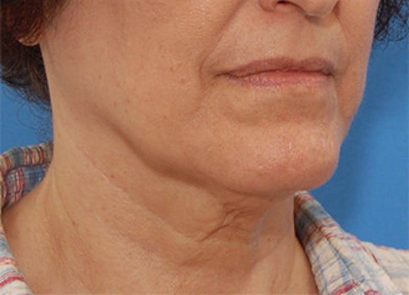 Facelift Before & After Gallery - Patient 119743 - Image 5