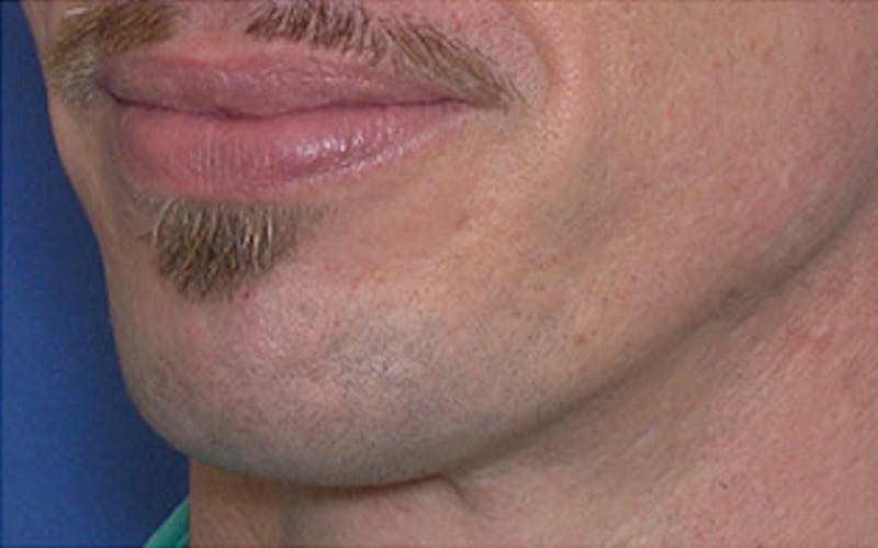 Chin Surgery Before & After Gallery - Patient 346731 - Image 6